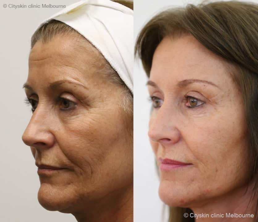 What to expect after facial fillers?